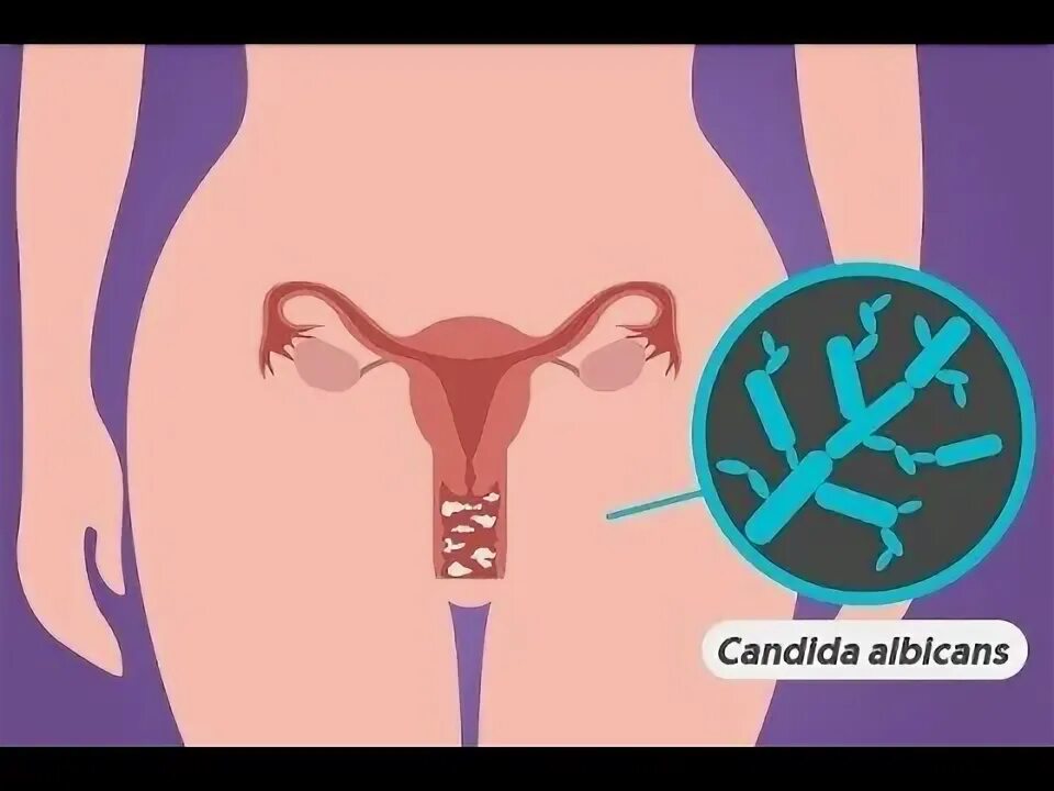 Вагинальный кандидоз и антибиотики: четкий план профилактики молочницы
