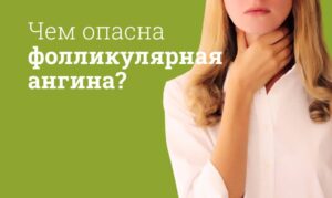 Ангина Фолликулярная лечение и симптомы у взрослых и детей: Клинические рекомендации